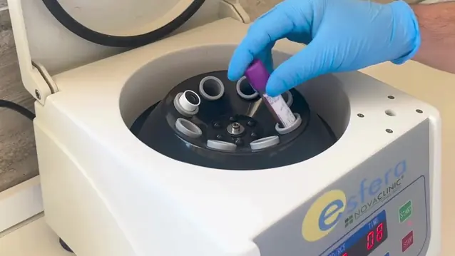 Medicina regenerativa y artrosis: PRP, células y exosomas